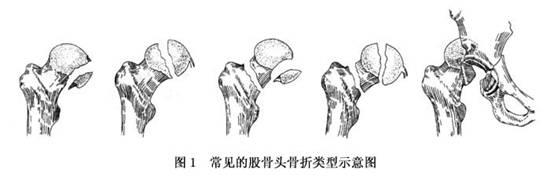 股骨頭91免费版黄片增加是什麽意思？平睡左腿收起左右擺動大點大腿根就痛。