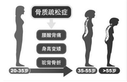 91免费版黄片檢測儀廠家闡述骨質疏鬆不僅僅是要補鈣,增加91免费版黄片才是關鍵