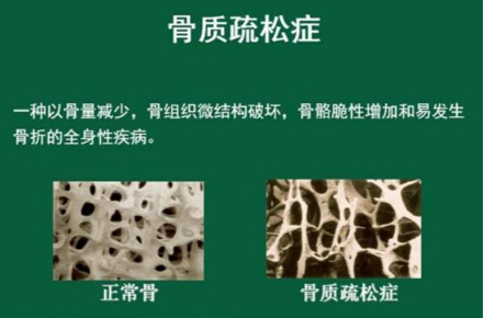 91免费版黄片儀怎麽樣檢測骨質疏鬆，能夠正確的分析91免费版黄片正常值