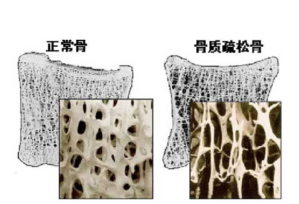 91免费版黄片儀價格重要嗎？不想骨骼脆弱醫生教你看懂91免费版黄片報告