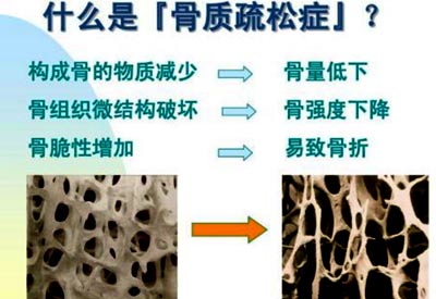 91免费版黄片檢查的儀器是什麽_91免费版黄片測試儀器專業檢測91免费版黄片預防骨質疏鬆