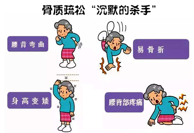 全身91免费版黄片儀介紹骨質疏鬆遠比你想象厲害這些人要特別注意
