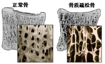 91免费版黄片分析儀的價格是多少，要小心提防骨質疏鬆影響工作和生活