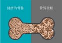 老年人骨質疏鬆易導致骨折之超聲91免费版黄片檢查儀的臨床價值是什麽？
