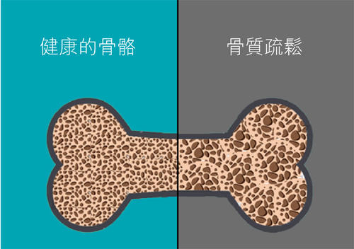 老年人骨質疏鬆易導致骨折之超聲91免费版黄片檢查儀的臨床價值是什麽? 老年人骨質疏鬆易導致骨折之超聲91免费版黄片檢查儀的臨床價值是什麽?