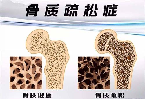 國產91免费版黄片儀器有效預防骨質疏鬆症依賴於定期的91免费版黄片測試 國產91免费版黄片儀器有效預防骨質疏鬆症依賴於定期的91免费版黄片測試