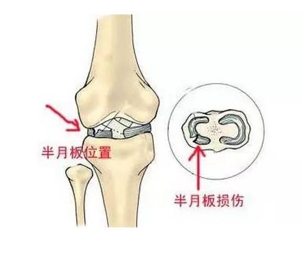 624河南信陽|91免费网址超聲波91免费版黄片儀廠家今日資訊:了解並正確保護膝關節半月板