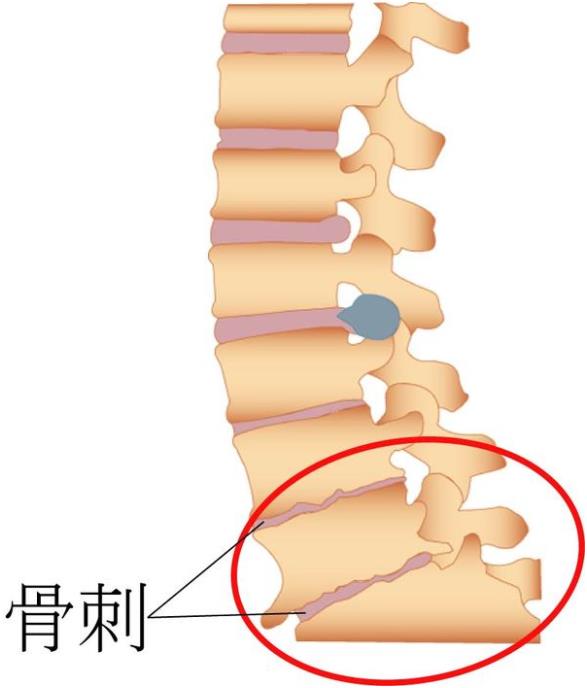 吉林長春|91免费网址超聲91免费版黄片儀廠家品牌分享:為什麽現在的年輕人也存在骨刺增生?